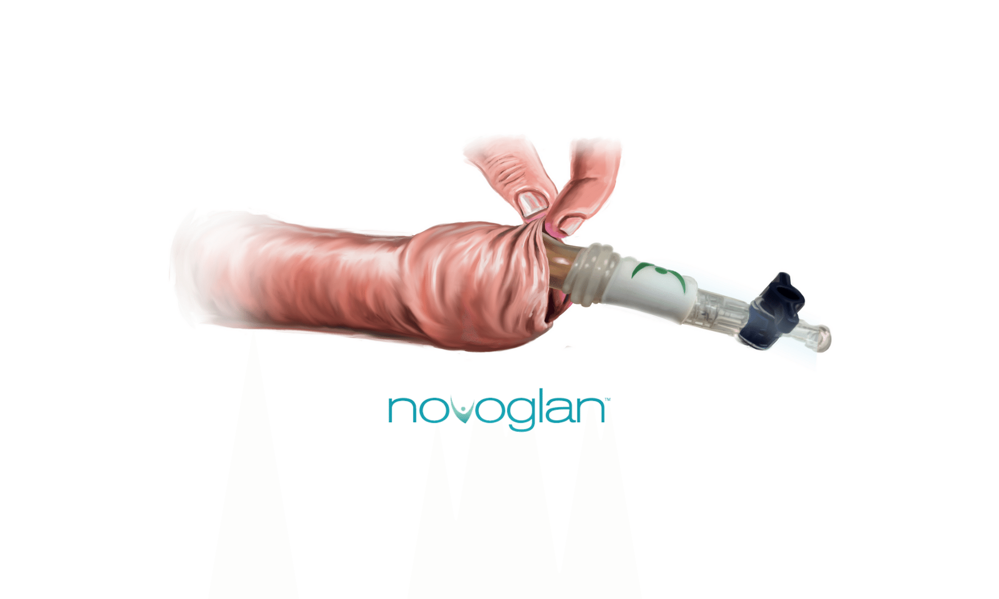 Novoglan - the gold standard in phimosis treatment! - Suffering