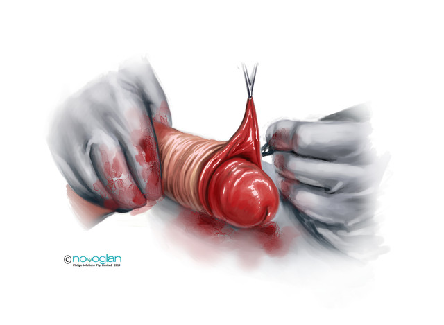 complications of circumcision